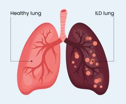 Symptoms of ILD and Sarcoidosis