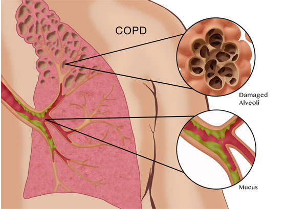 COPD treatment in Rawalpindi