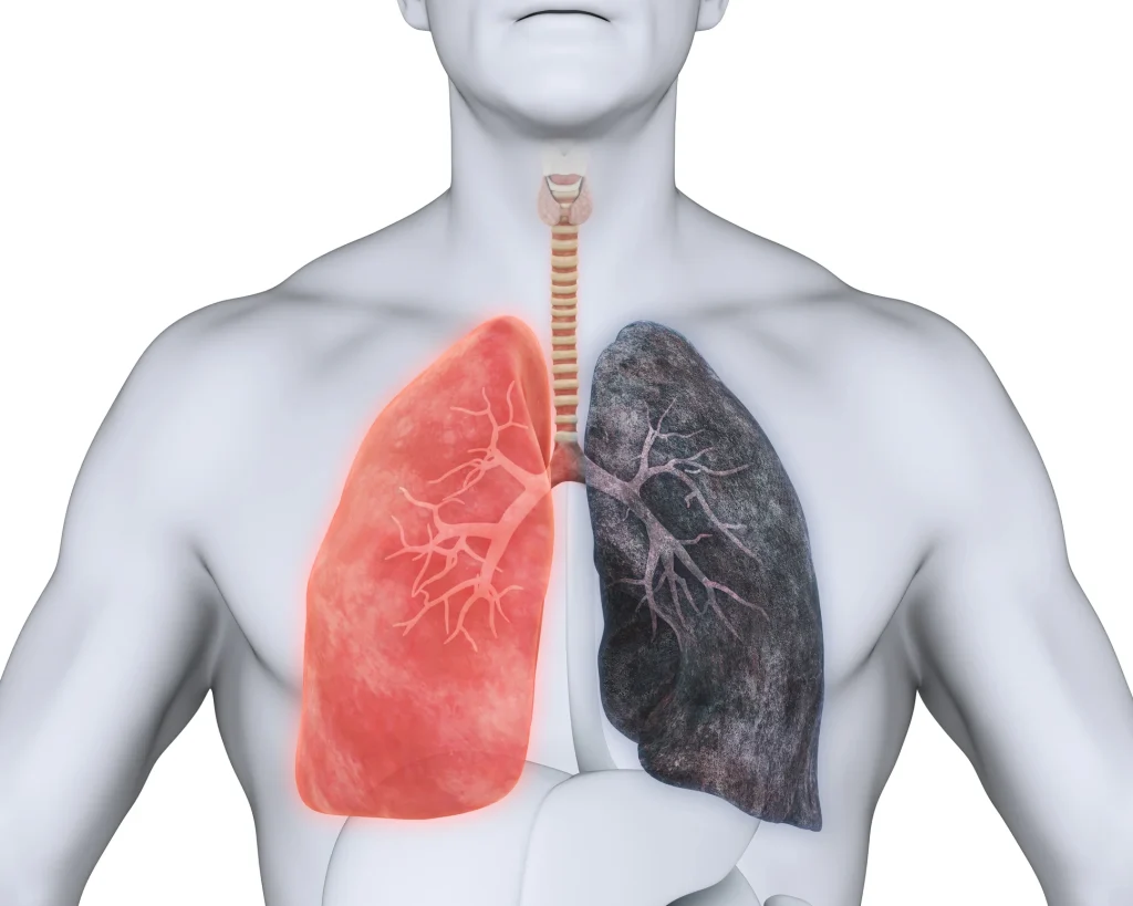COPD treatment in Rawalpindi